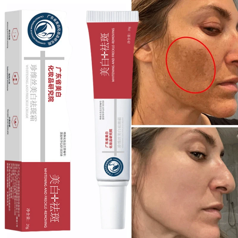 Freckle Whitening Cream Black Dots Melasma Remover Anti Brown Stain Lighten Pigmentation Moisturizing Skin Care Korean Products