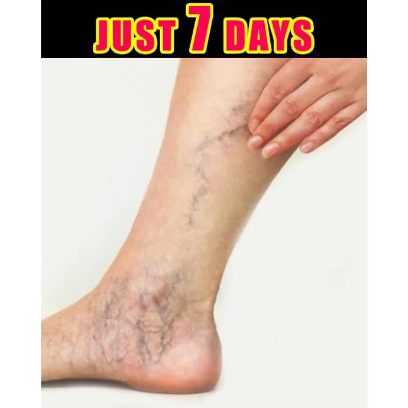 Varicose Veins and Spider Legs Repair Cream Soothes Pain and Enhances Skin Elasticity Solve Foot Skin Problems