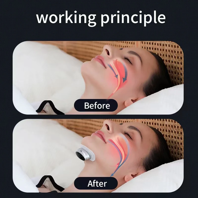 Intelligent Anti Snoring Device With Dual Pulse Throat Muscle Massage To Prevent Snoring And Effectively Improve Sleep Quality