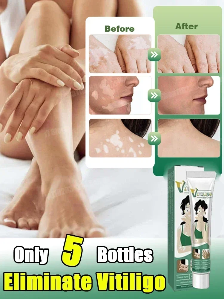 

Reduce white spots Skin care Vitiligo Removal Cream White Spot Cream Skin care cream vitiligo skin Sweat spot