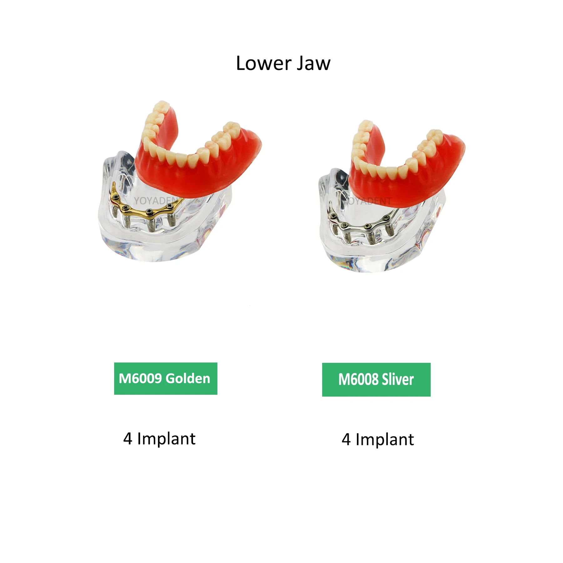 

Dental Overdenture Teeth Model Mandibular Lower Jaw 4 Precision Implants Demo For Dental Tooth Teaching