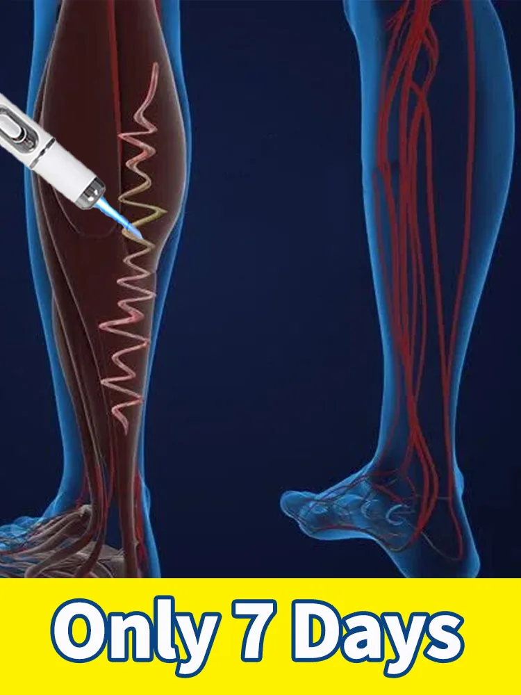 

Generation-2 Laser Says Goodbye To Spider Legs Varicose In 7 Days