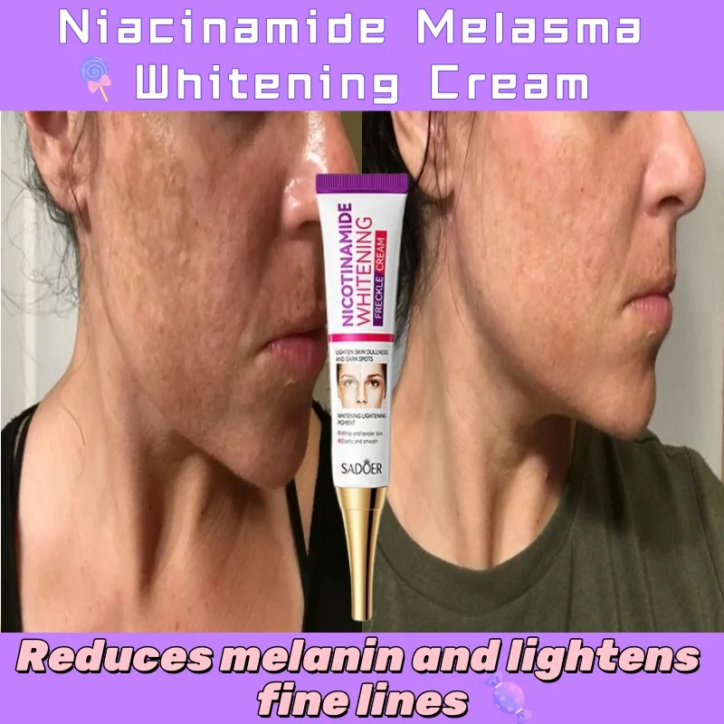 Niacinamida Melasma Whitening Cream, Reduz a melanina, Pele escura, Clareia linhas finas, Cuidado facial, Cuidado coreano