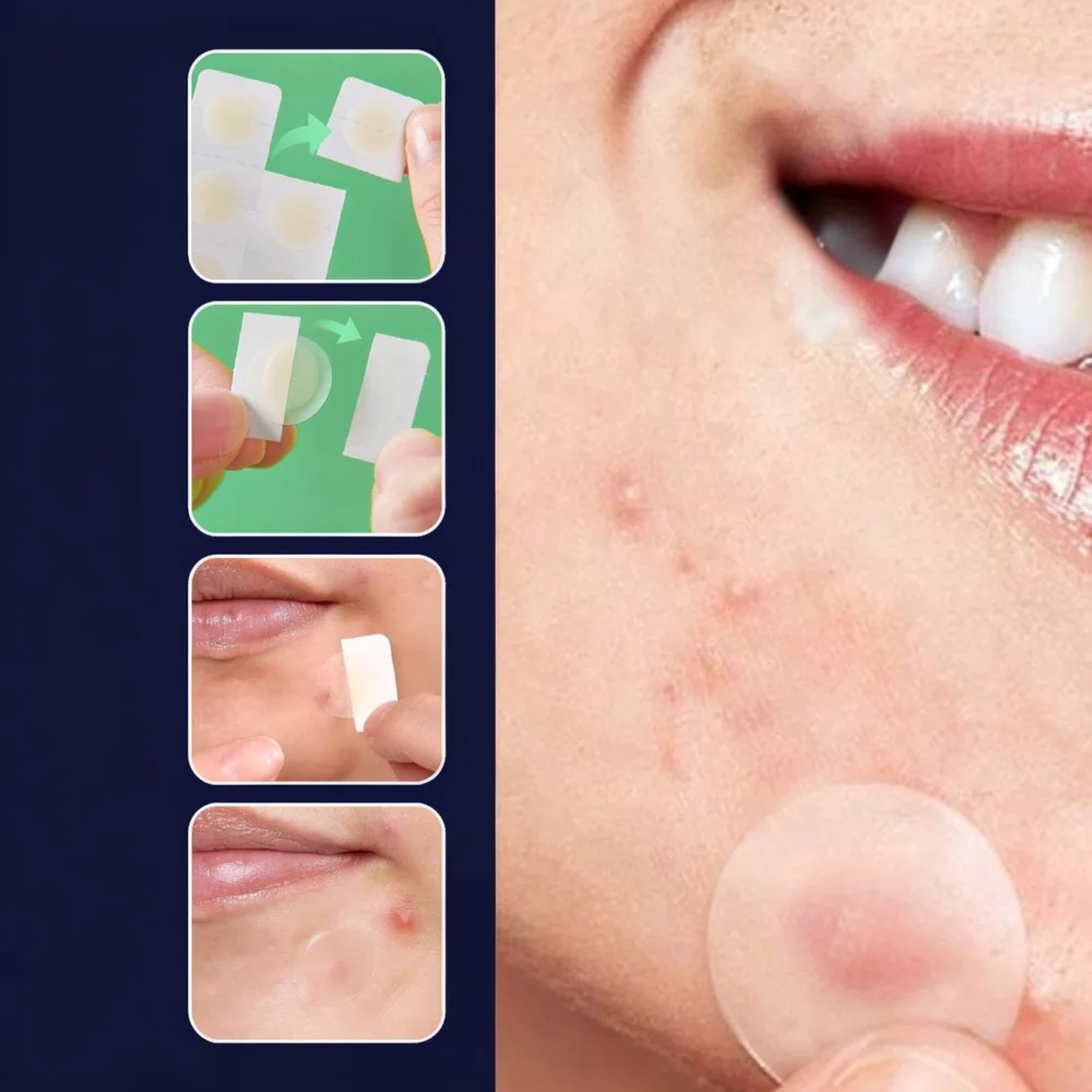 Invisible Acne Pimple Sticker Facial Cleansing Swab Kit Hydrocolloid Skin Care Treatment Tool Blemish Remover Patch Set