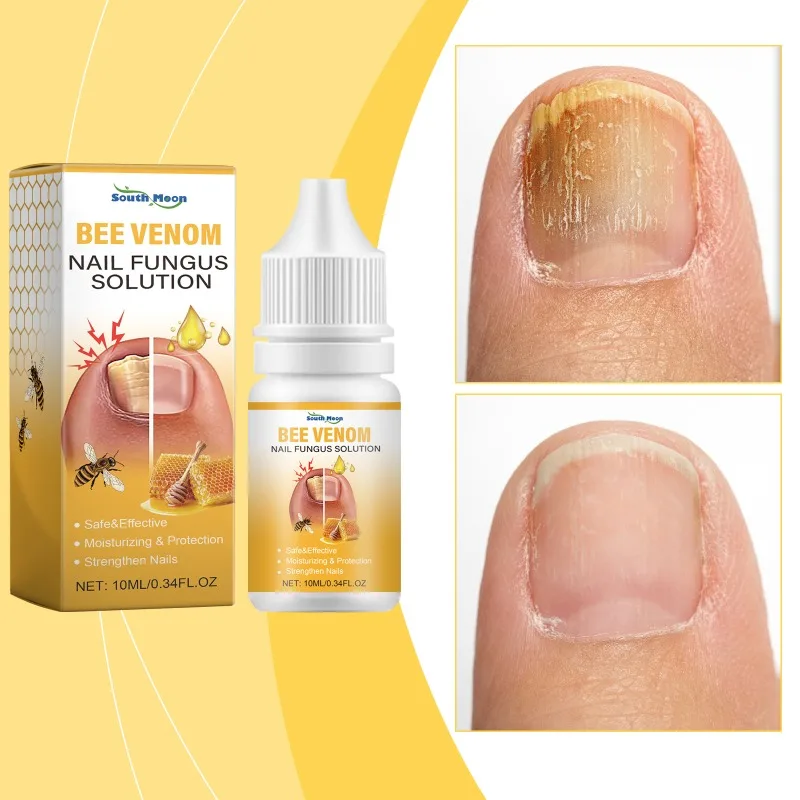 Bee Venom Nail Fungus Solution Hand Foot Care Toenail Thickening Yellowing Essence Ingrown Nail Gray Bright Nail Repair Product