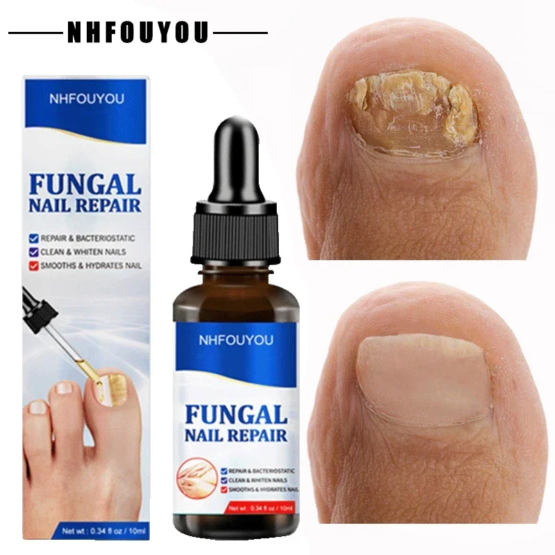 Aceite para tratamiento de uñas por hongos, esencia para reparación de pies, Gel para eliminación de hongos en las uñas de los pies, crema antiinfección, 10ML