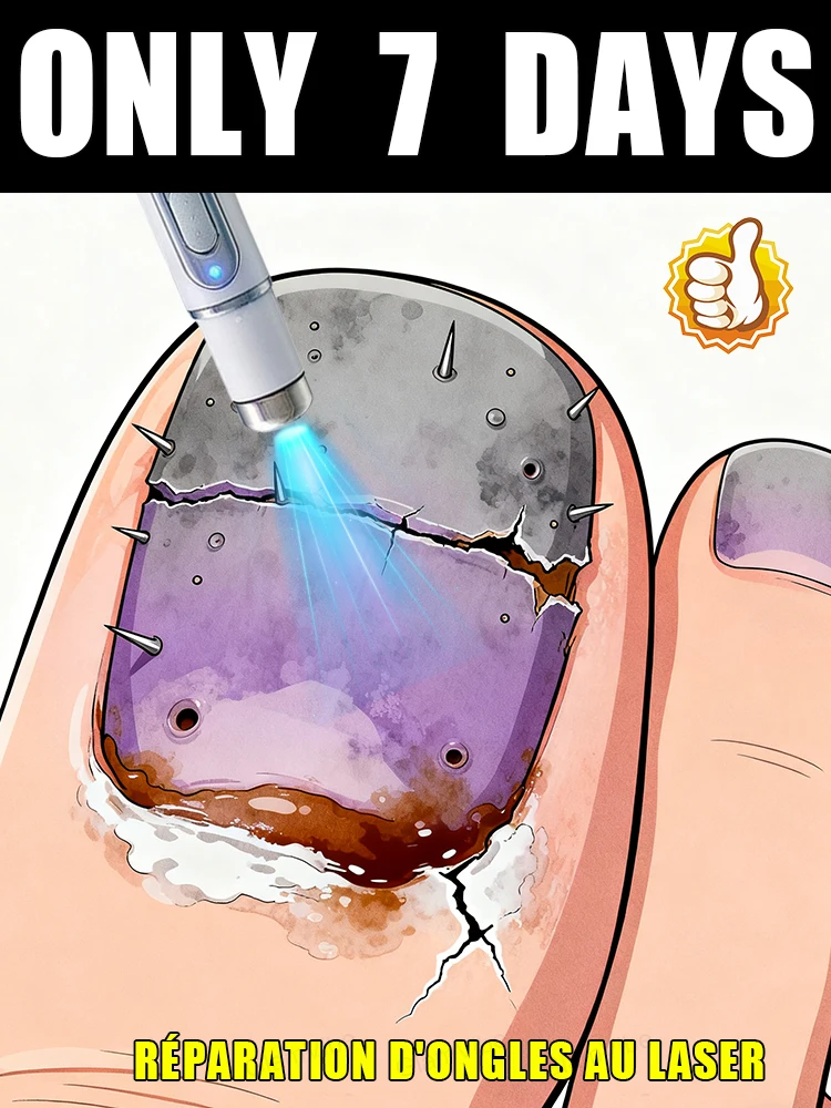 

Laser treatment for nail fungus and removal of onychomycosis