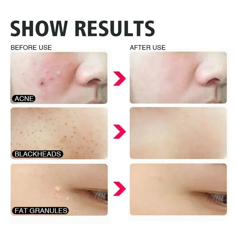 Thumbnail 4 - #52 Latest Skin Care Extractors Offers