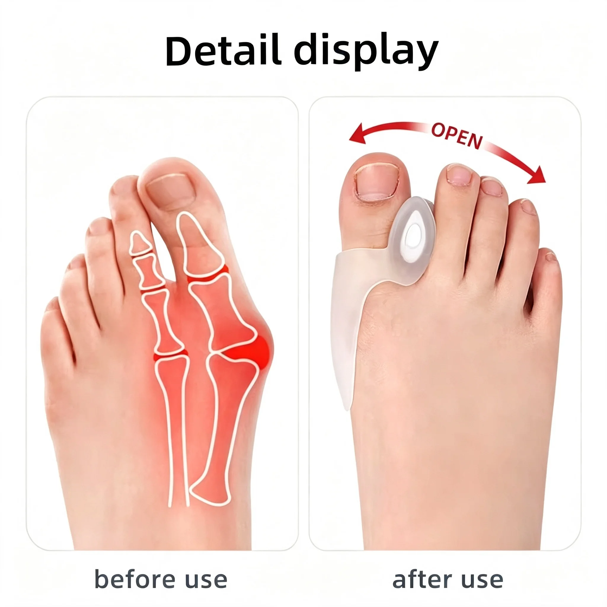 1 Set of Bunion Correctors – Adjustable, Soft, and Anti-Chafing Foot Protectors