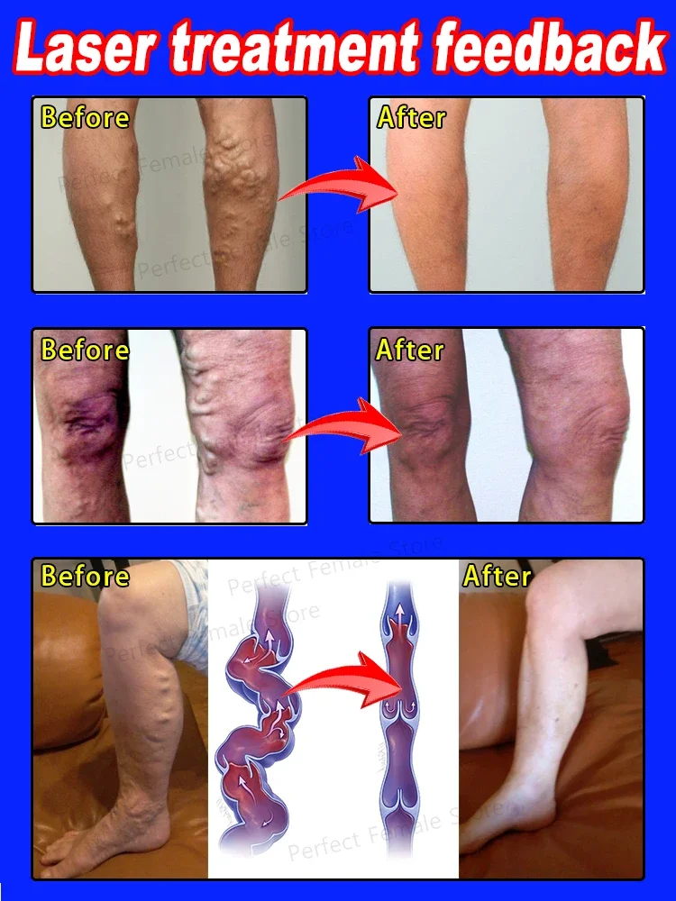 Varicose Veins Products