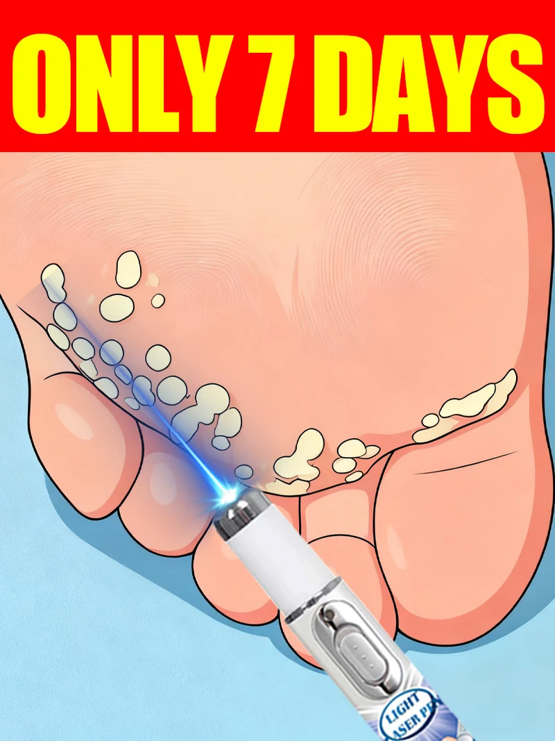 

Generation-3 Laser Says Goodbye To all warts In 7 Days