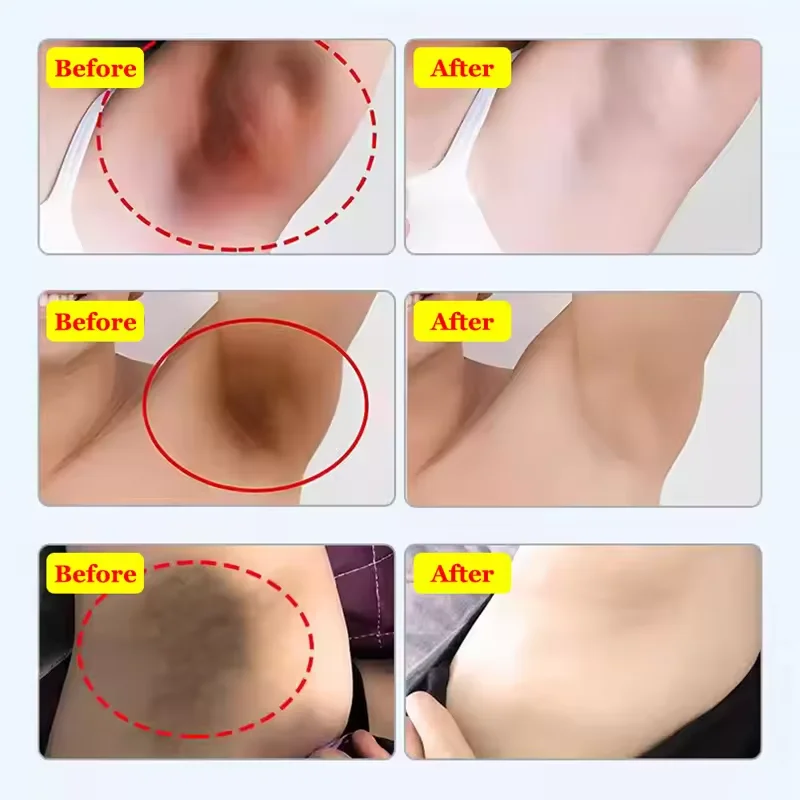 كريم تبييض الأجزاء الخاصة تحت الإبط مصل تبييض تبييض بعقب الركبة سطع الفخذ الداخلي الأجزاء الحميمة إزالة الميلانين الداكن