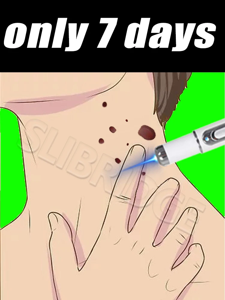 blue light pen solve warts, New Upgrade wart care tools,2025 hot sale,unisex,More discounts on sets