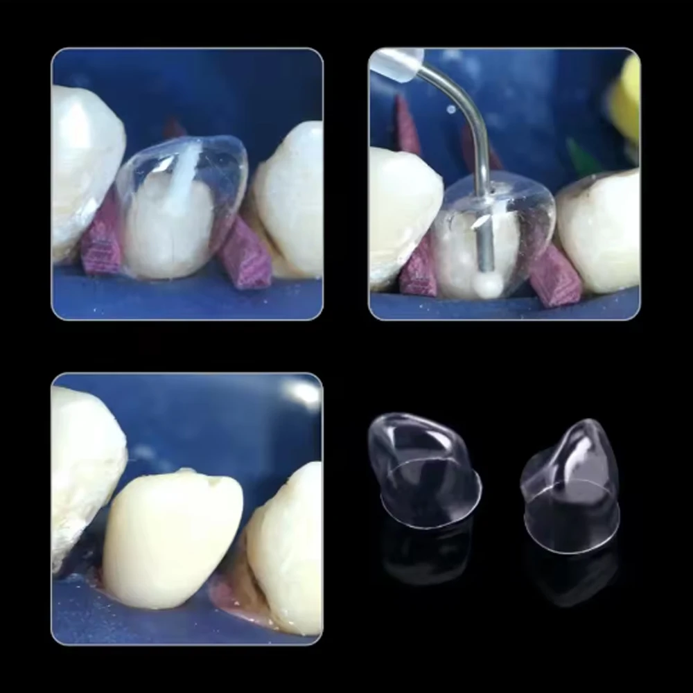 Crowns Transparent Temporary Preformed Molar Dental Anterior Posterior Teeth Deciduous 64pcs/Box Child Adult Kids Matrix Kit