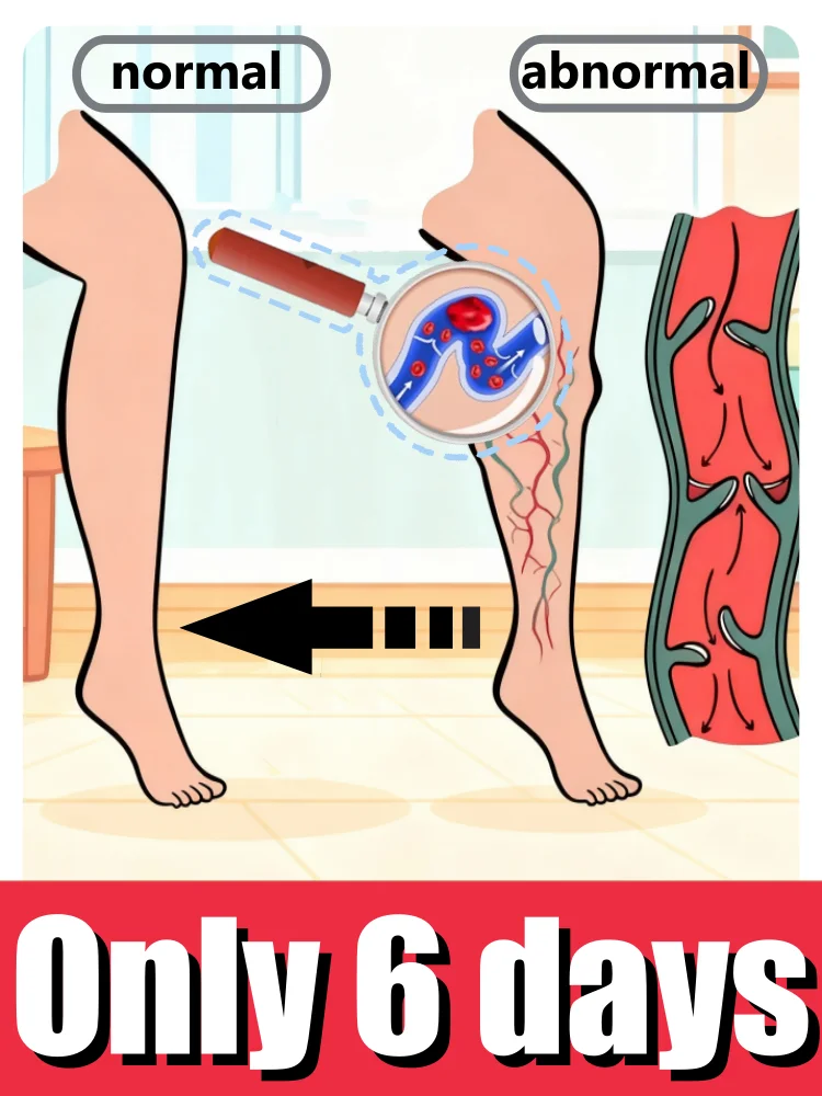 Bolígrafo optimizador de venas 2025: para venas varicosas, dios adiós al enrojecimiento en las piernas