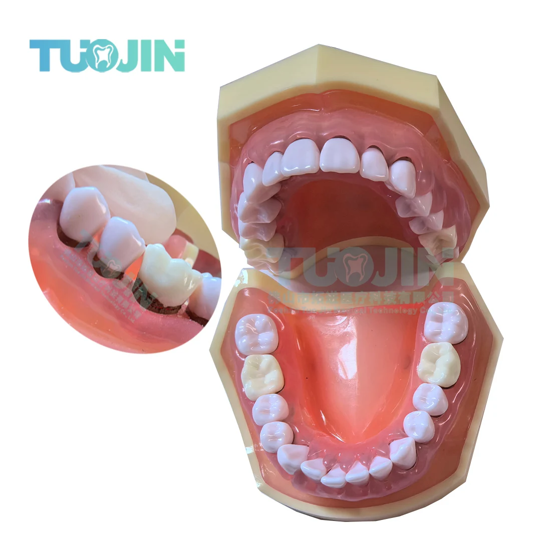 Dental Typodont Manikin Periodontal  Model for Orthodontic Education Demonstrates Severely Inflamed Gingivae with Calculus