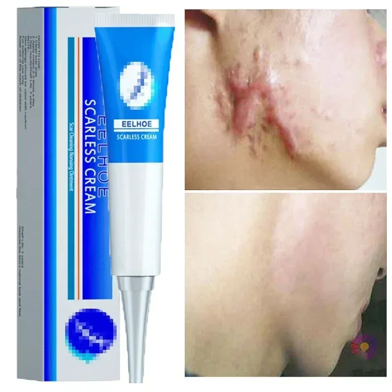 Scar cream gel effective repair surgical scars stretch marks acne pits pockmarks burn scars repair treatment