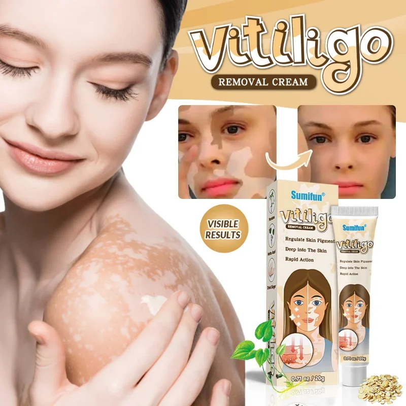 Vitiligo Cream Reduce White Spots Melanin Deposits Repair Skin Leukoplakia Disease Relieve Skin Itch Herbal Ointment Care 20g