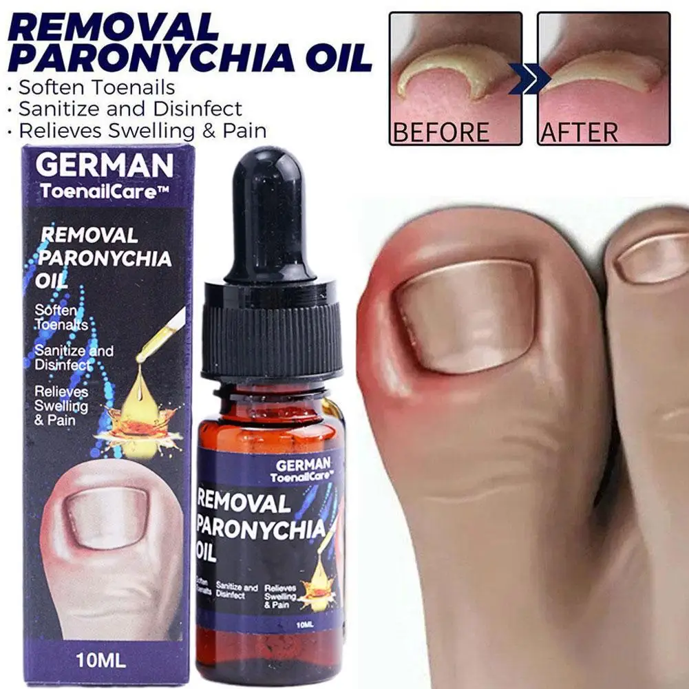 Toenailcare Removal Paronychia Oil Ingrown Toenail Treatment Best Nail Repair Solution Nail Renewal Liquid 10ml