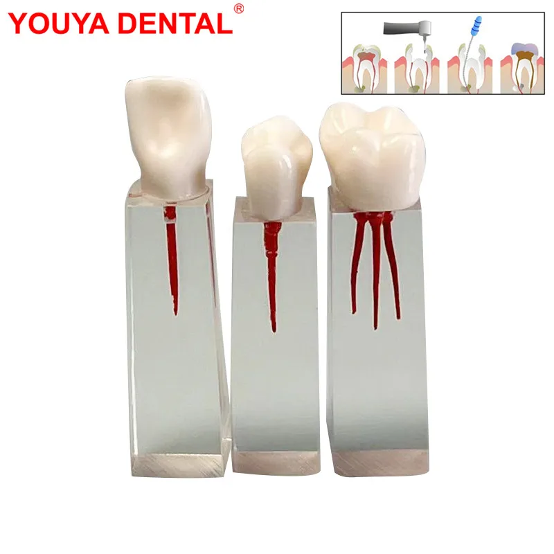 

3pc Dental Model Endodontic Transparent Endo Root Canal Dental Teeth Study Model Endodontic Treatment Training Practice RCT Demo