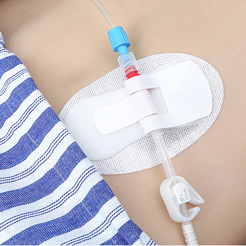 1Pcs Adhesive Catheter Fixator Urinary Tract Fixation Band Device Anchor Nephrostomy G-type Fixator