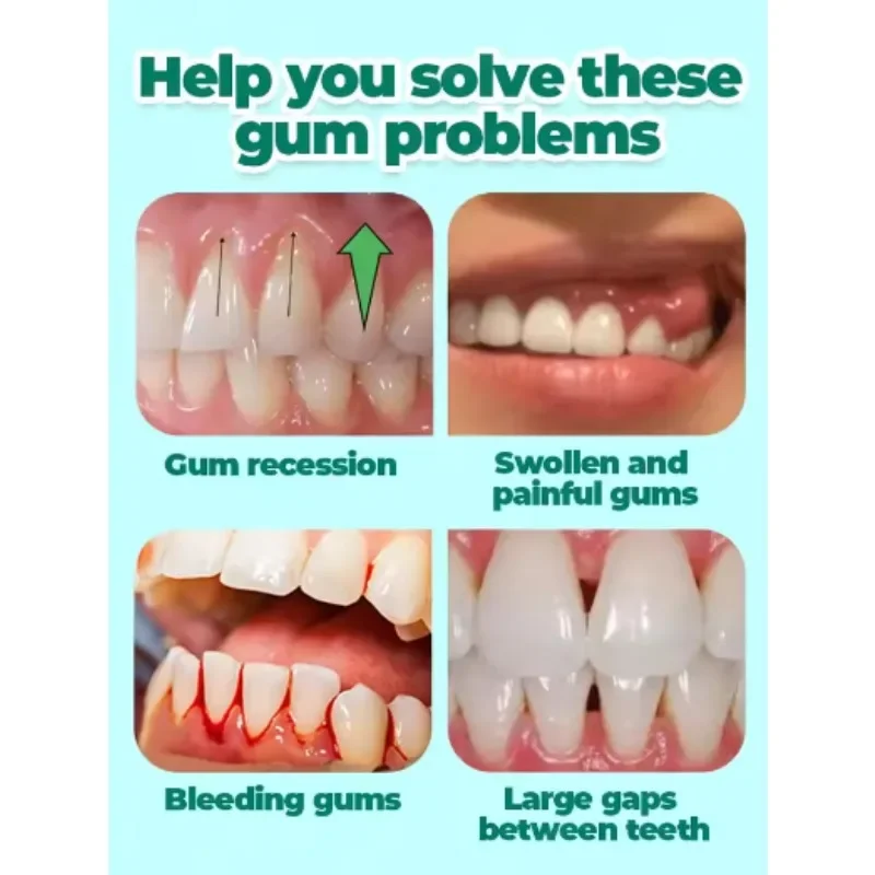 Гель для терапии десен Гель для терапии десен от зубов, отбеливание зубов, лечение неприятных десен, защита дыхания полости рта, гель для восстановления