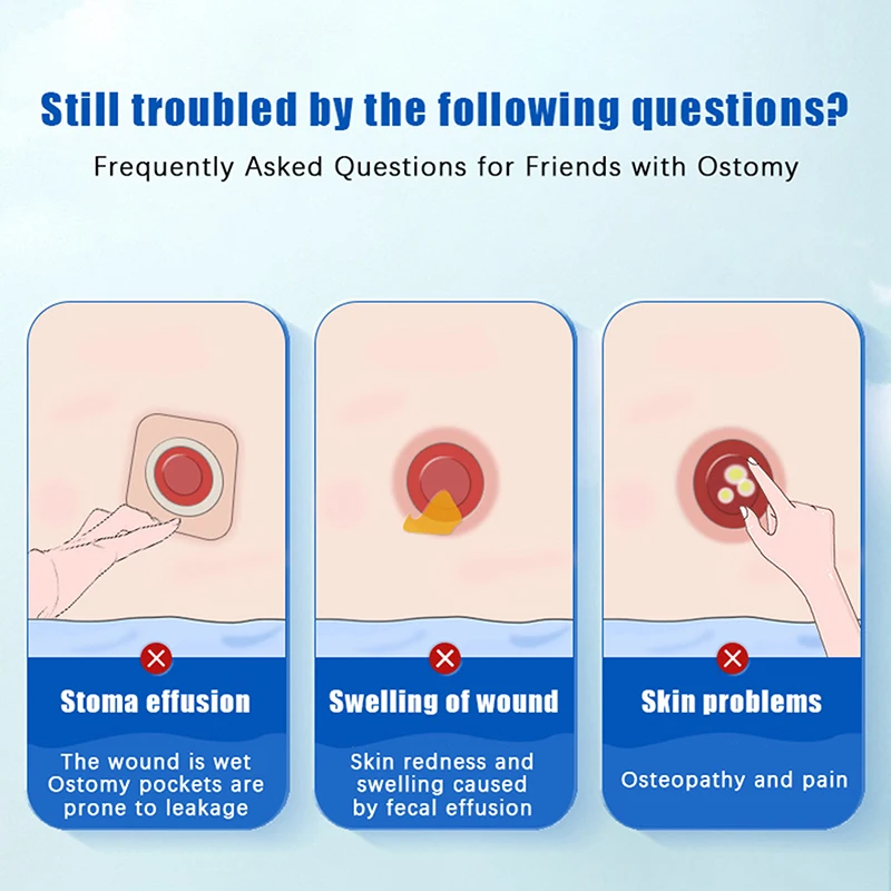 Medical Stoma Powder: Hypoallergenic Odor-Control Dry Protection for Ostomy & Colostomy Bag Care