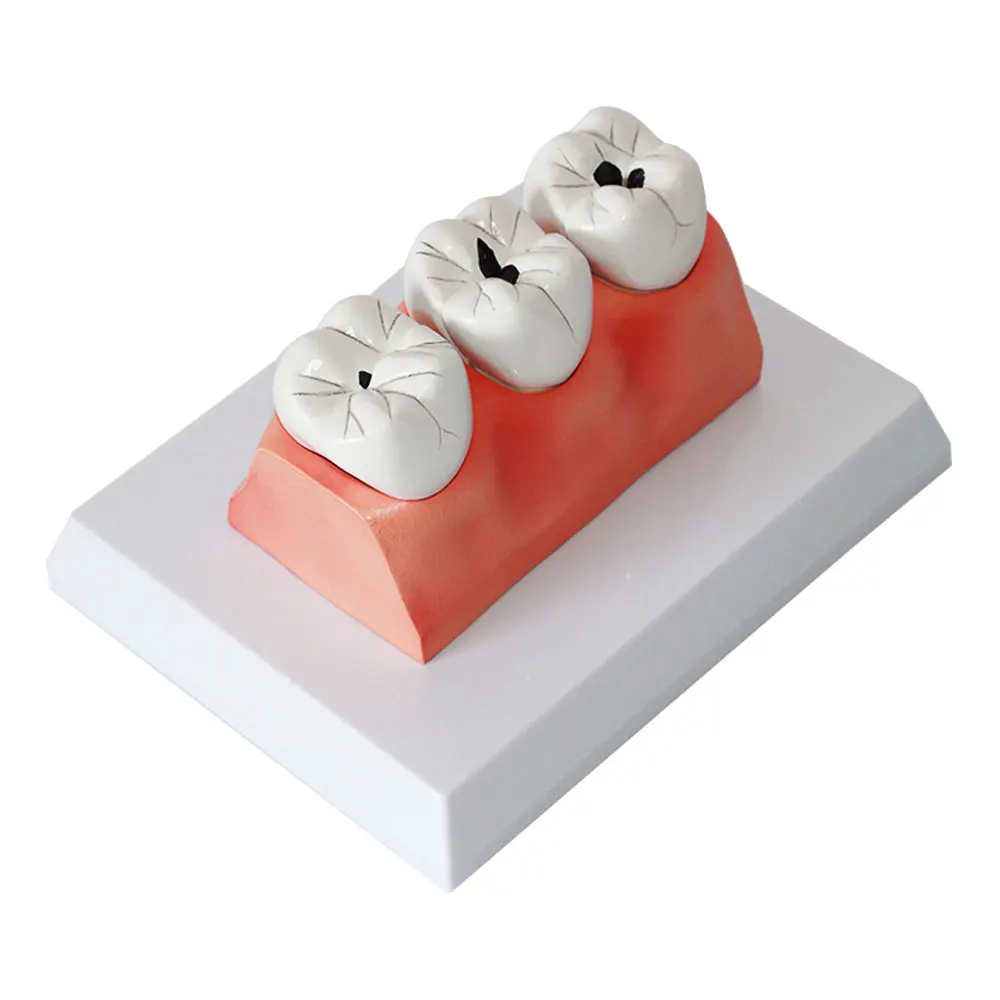 Dental Department: Pediatric Insect Tooth Decay Model, Pathological Caries Anatomy Model