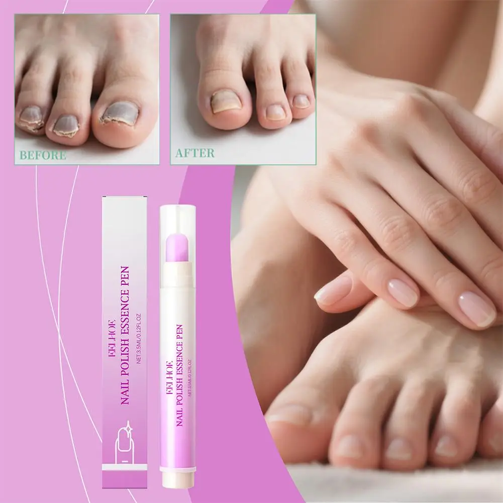قلم إصلاح عدوى الأظافر مضاد للفطار الداحس القلم الفطريات اصفرار تغير لون الأظافر تحسين الرعاية إزالة أظافر N N1K5 #1