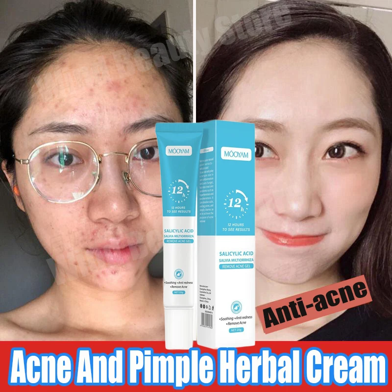 Acne Cream For Face Pimples Remover Treatment Shrink Pores Oil Control Lighten Acne Marks Whitening Smoothing Facial Skin Care