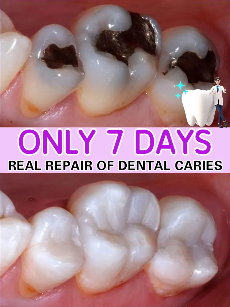 Tooth decay Repair Repairing Cavities Anti Protecting Caries