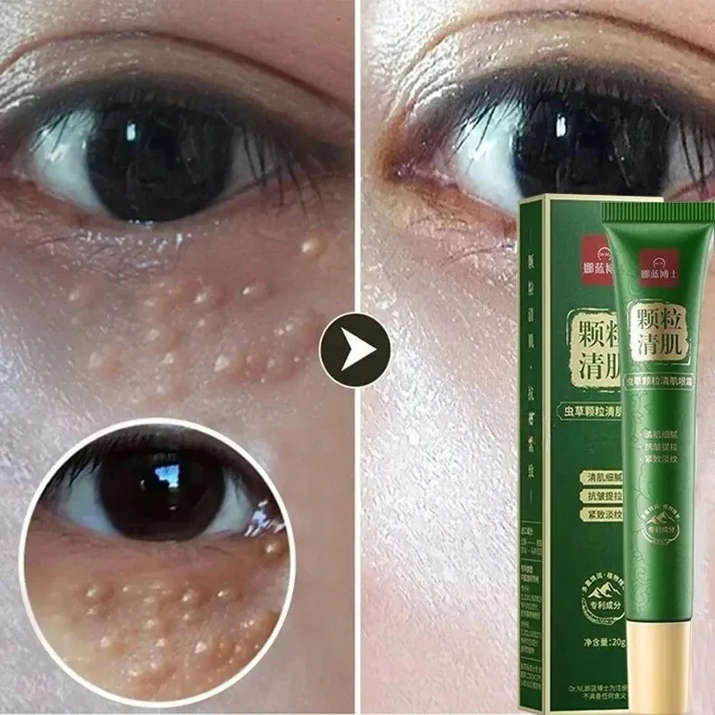 Fat Granules Remover Eye Cream Anti-Puffiness Anti Inflammatory Reduce Dark Circles Eyebags Fade Lines Moisturizing Eye Care view 3