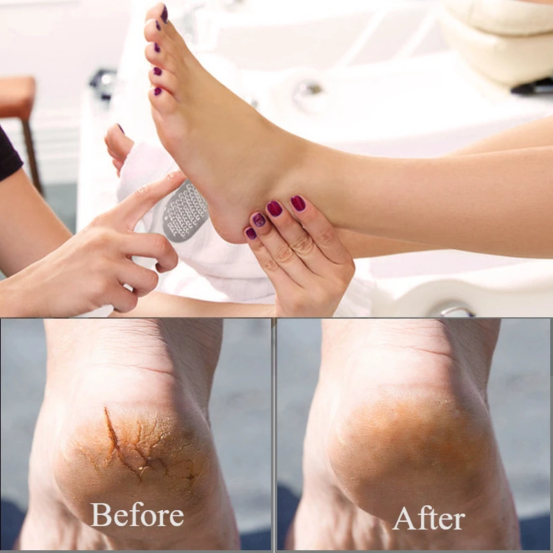 Râpe à pied, râpe à talon, dissolvant de callosités de peau dure et morte, grattoir professionnel, outils de pédicure pour produits de soins des pieds