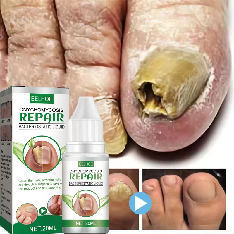 زيت علاج الأظافر الفطرية، إصلاح القدم، جوهر إزالة فطريات الأظافر، كريم مضاد للعدوى، إزالة الأظافر الفطرية
