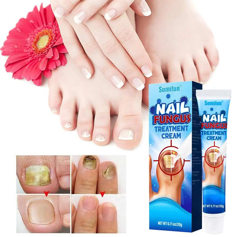 20g Effective Nail Treatments Cream Nail Fungus Removal Ointment Toenail Soft Repair Nail Cream Onychomycosis Paronychia F0C6