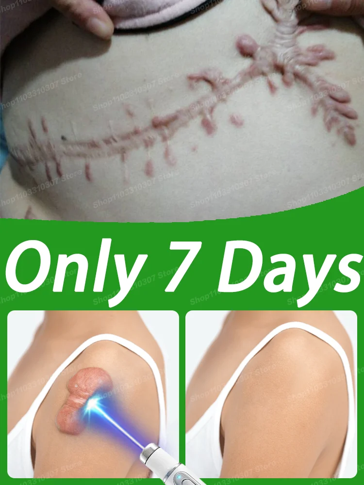 

Keloid Scar Quickly Therapy