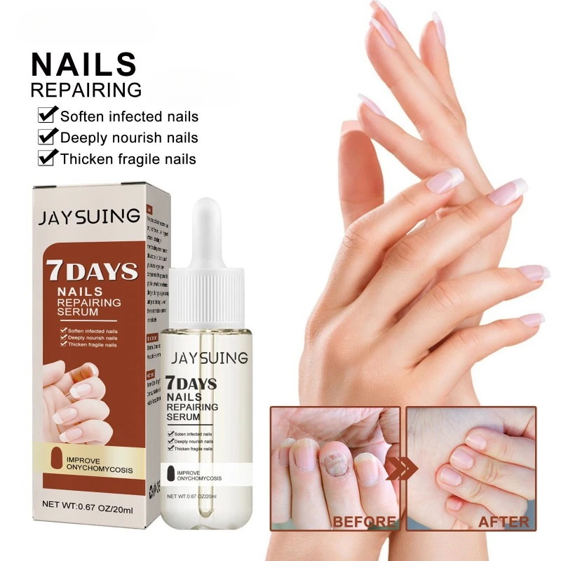 Fast Fungal Nail Treatments Serum Onychomycosis Ingrown Toenails Paronychia Anti-infective Fungus Foot Repair Essences Care