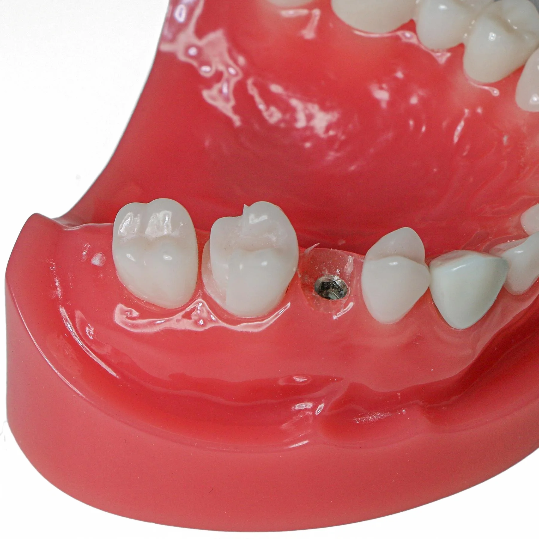 Afbeelding 7: M6024 Dental Post Core Bridge Overdenture Model Implantaatrestauratiemodel