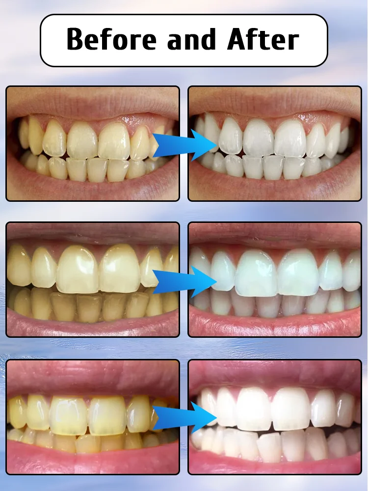 

Blueberry Flavor Toothpaste - Stain Removal, Teeth Whitening