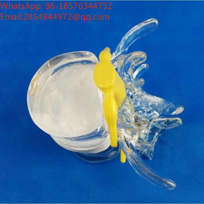 Demonstration Model of Human Lumbar Intervertebral Disc Compression Spine Pathological Prolapse of Spine