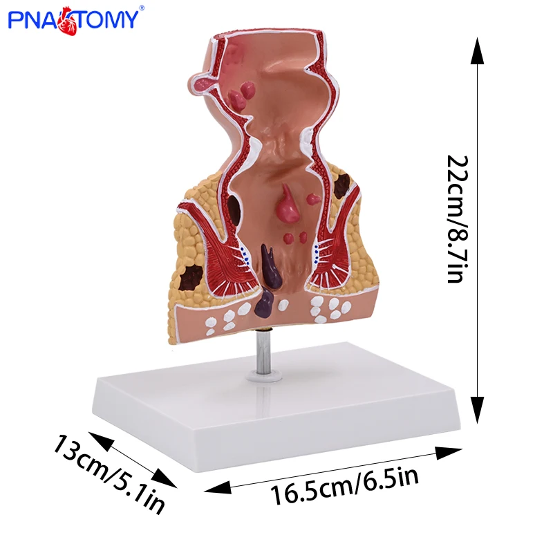 

Teaching Model of Rectal Pathology Model Intestinal Specimen Human Anatomy Model Hemorrhoids Anal Lesions Medical Gift