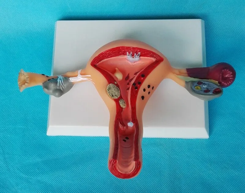 Female Pathological Uterus Model Obstetrics Gynecology Uterus Anatomical Structure Simulation Diseased Uterus Teaching Model