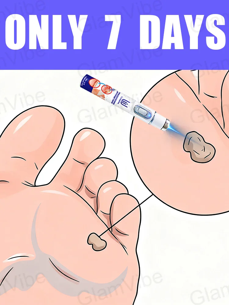 

2025 New Upgrade Blue Laser Solve Wart Tool