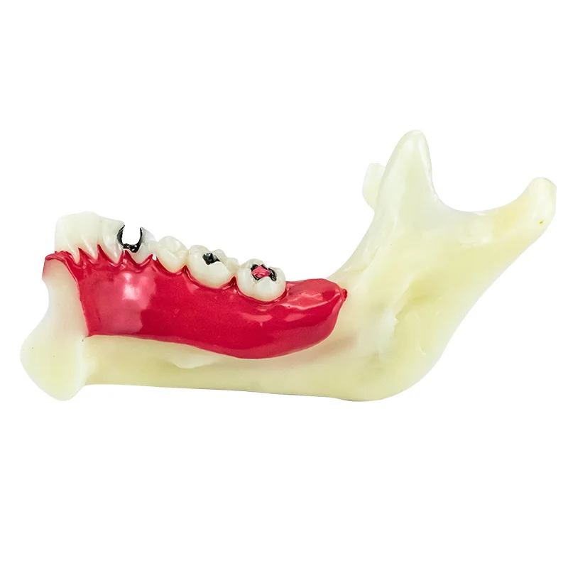 Dental Endodontic Treatment Model Anatomy of Gums Mandible Tissue Anatomical Model Dentist Teach Study Demonstration Teeth Model