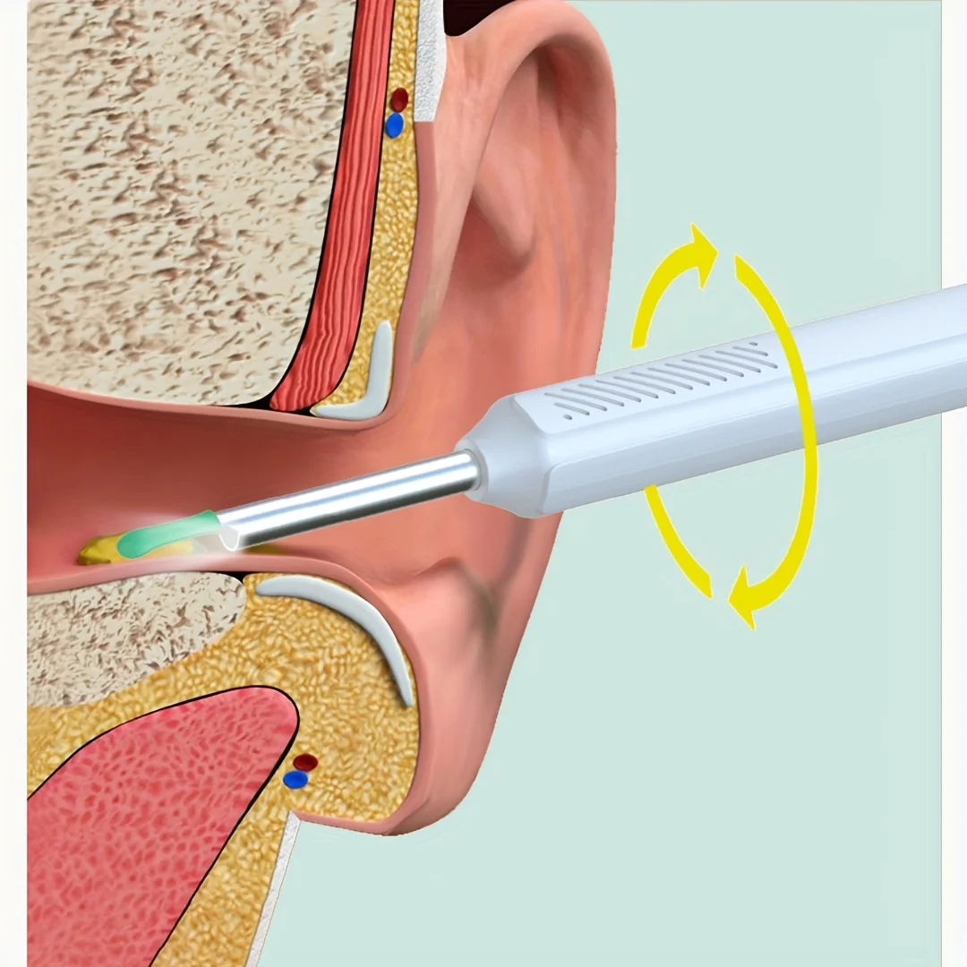 مجموعة أدوات إزالة شمع الأذن، 1080 بكسل عالية الوضوح، ضوء LED، عرض التطبيق، مع 6 رؤوس ملعقة قابلة للاستبدال، شحن USB