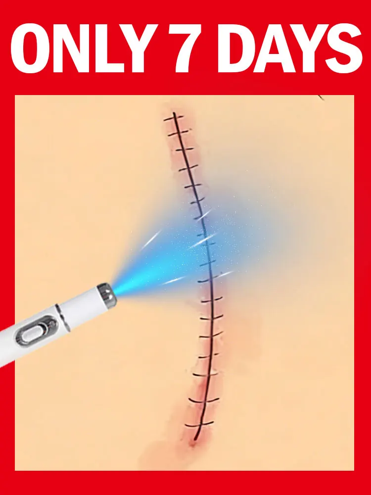 

Blue light laser New upgrade product No Scar