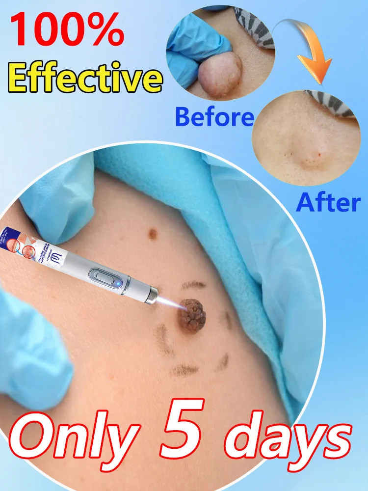 

Laat alle wratten op je lichaam verdwijnen