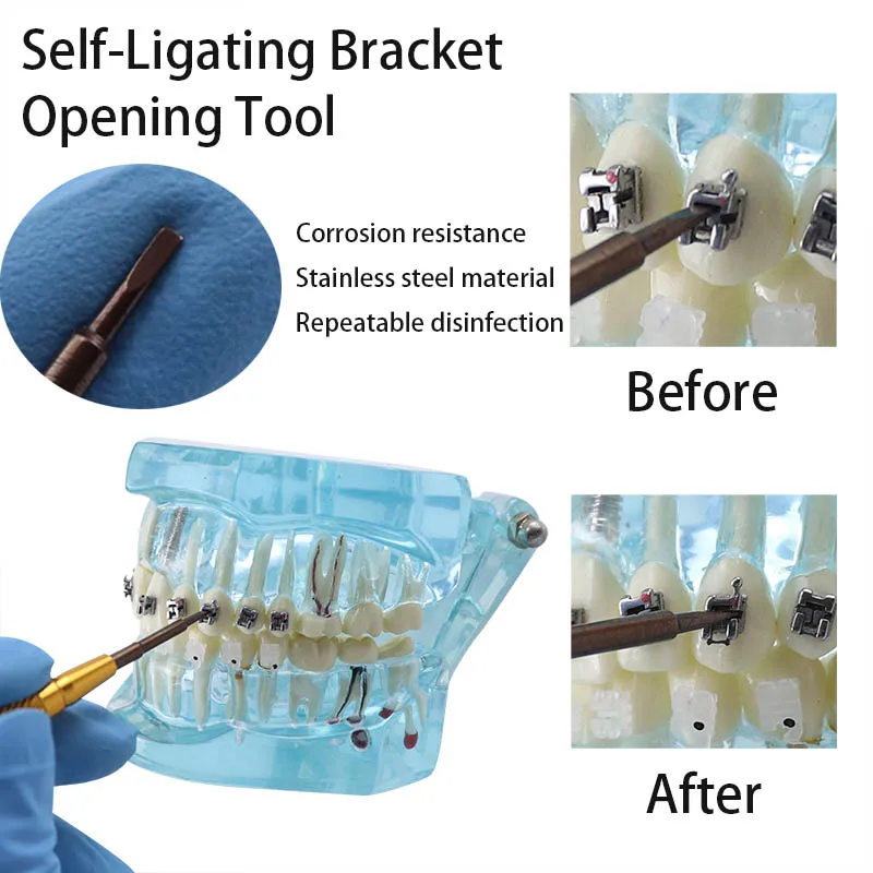 1pc Dental Opener Orthodontic Self Ligating Passive Bracket Brace Open Close Tool Single Ends Opening Instruments