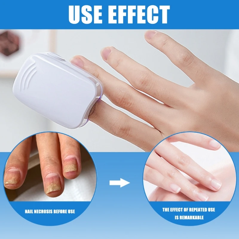 Fungi Remover Practical Fungi Cleaning Device for Nail Therapies Dropship