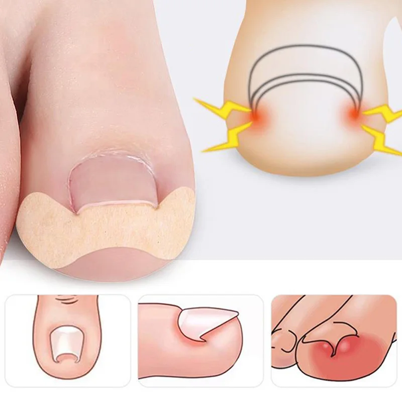 20-100Pcs Professional Ingrown Toenail Foot Corrector Stickers Elasticity Nail Care Pedicure Tools Health Care Protects Toe Nail